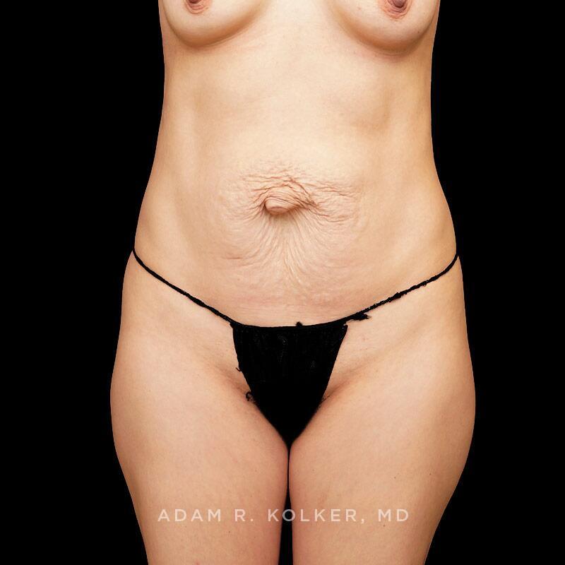 Tummy Tuck Before Image Patient 13 Front View
