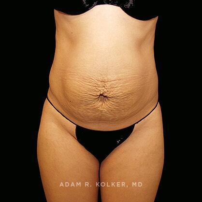 Tummy Tuck Before Image Patient 26 Front View