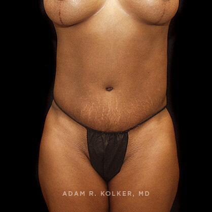 Tummy Tuck After Image Patient 36 Front View