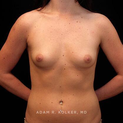 Breast Augmentation Before Image Patient 14 Front View
