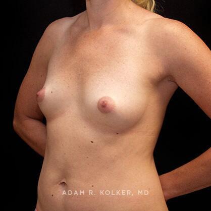 Breast Augmentation Before Image Patient 46 Oblique View