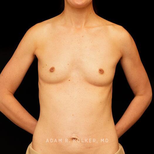 Breast Augmentation Before Image Patient 88 Front View