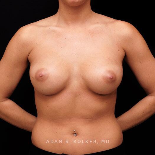 Breast Augmentation After Image Patient 98 Front View