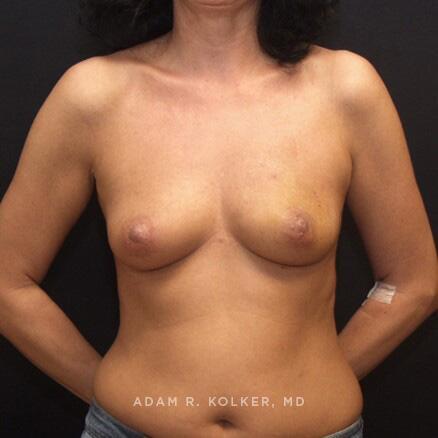 Breast Reconstruction Before Image Patient 05 Front View