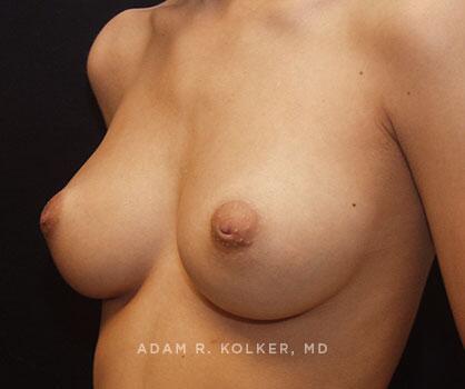 Inverted Nipple Correction Before Image Patient 01 Oblique View