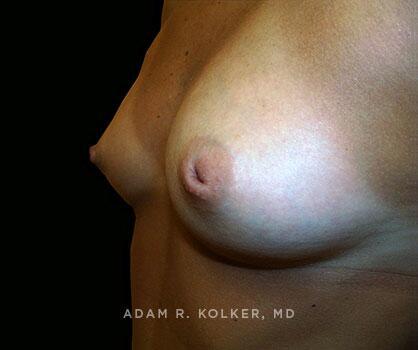Inverted Nipple Correction Before Image Patient 02 Oblique View