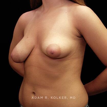 Tuberous Breast Correction Before Image Patient 03 Oblique View