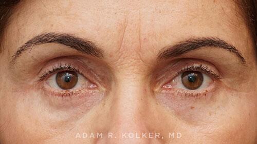 Blepharoplasty After Image Patient 10 Front View