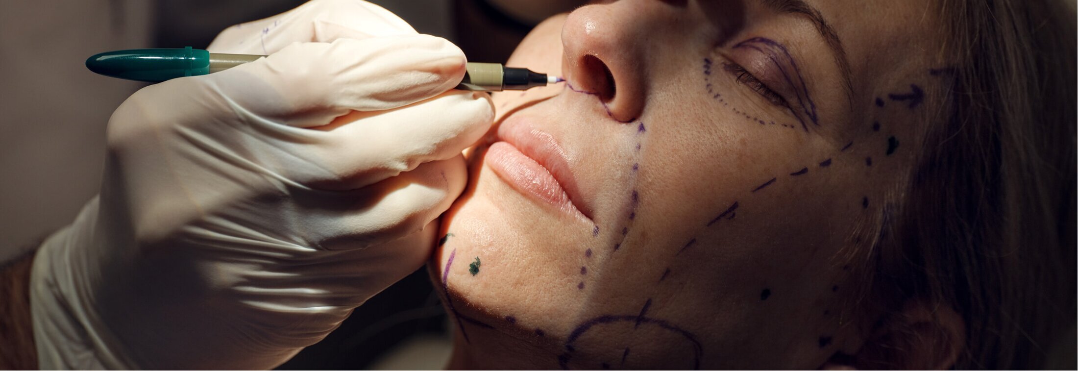 facelift consultation drawing lines on face